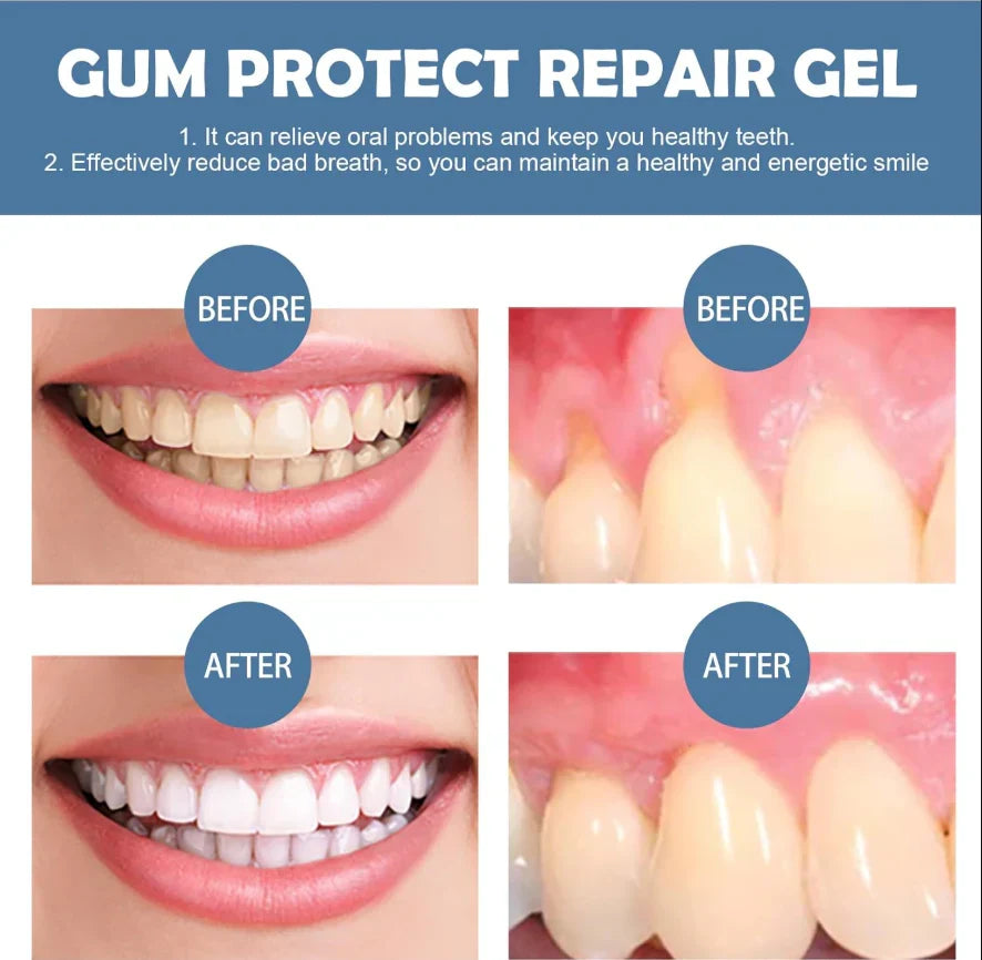 【New upgrade】Caelvya Gum Protect Dental Repair Gel【3 tubes/box】