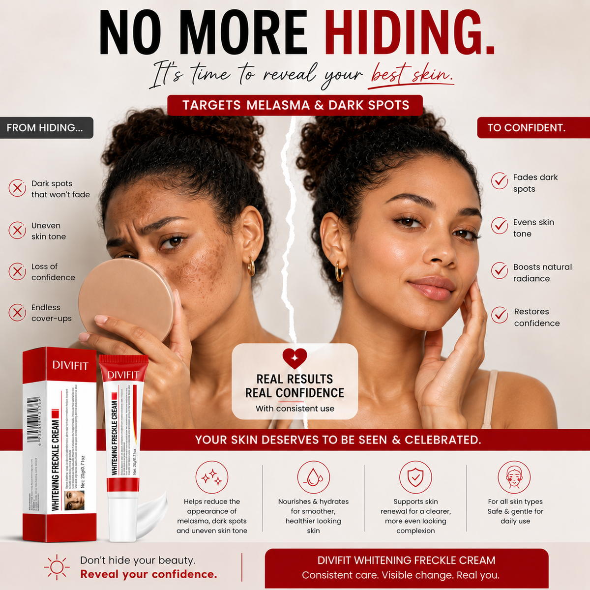 Melasma, Freckles and Dark spot Removal Cream