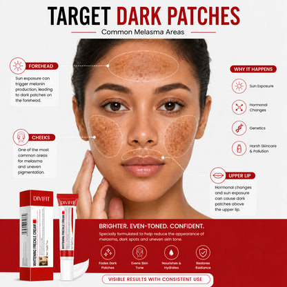 Melasma, Freckles and Dark spot Removal Cream