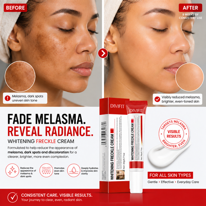 Melasma, Freckles and Dark spot Removal Cream