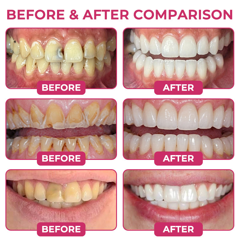 Covernia® DenPerm Cavity-Repair Natural Enamel Filling Gel
