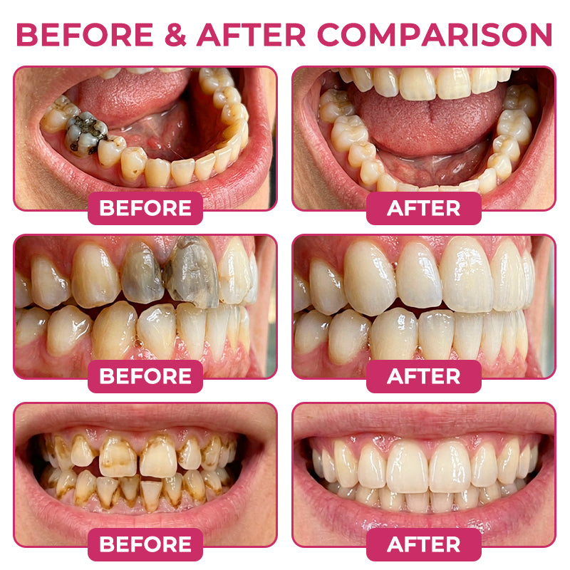 Covernia® DenPerm Cavity-Repair Natural Enamel Filling Gel